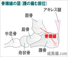 骨端線の図(踵の痛む部位)